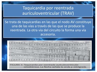 Taquicardia por reentrada
aurículoventricular (TRAV)
Se trata de taquicardias en las que el nodo AV constituye
una de las vías a través de las que se produce la
reentrada. La otra vía del circuito la forma una vía
accesoria.
 