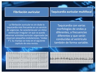 Fibrilación auricular
La fibrilación auricular es sin duda la
taquicardia más frecuente en un servicio
de urgencias. Se caracteriza por un ritmo
ventricular irregular sin que se pueda
observar actividad auricular organizada (se
observan pequeñas ondulaciones, “ondas
f”). Su manejo se trata en el siguiente
capítulo de esta revista.
Taquicardia auricular multifocal
Taquicardia con varias
morfologías de ondas p
diferentes, a frecuencias
diferentes y que serán
conducidas al ventrículo
también de forma variable.
 