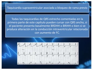 Taquicardia supraventricular asociada a bloqueo de rama previo
Todas las taquicardias de QRS estrecho comentadas en la
primera parte de este capítulo pueden cursar con QRS ancho, si
el paciente presenta basalmente BRDHH o BRIHH o bien si se
produce alteración en la conducción intraventricular relacionada
con aumento de FC.
 