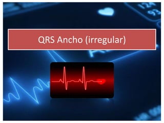 QRS Ancho (irregular)
 