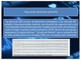 Taquicardia ventricular polimorfa
Se observan QRS anchos, de diferentes morfologías y con intervalo RR
variable. Estas taquicardias implican una situación de urgencia vital y son
mal toleradas hemodinámicamente. Pueden presentarse clínicamente
como síncope o parada cardiorrespiratoria (PCR). Dentro de este grupo
destacamos la taquicardia por “Torsada de Pointes” que se presenta con
un ECG característico con complejos QRS con una disposición helicoidal.
 