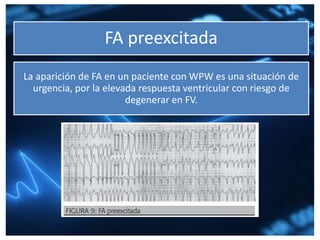 FA preexcitada
La aparición de FA en un paciente con WPW es una situación de
urgencia, por la elevada respuesta ventricular con riesgo de
degenerar en FV.
 