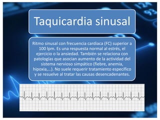 Taquicardia sinusal
Ritmo sinusal con frecuencia cardiaca (FC) superior a
100 lpm. Es una respuesta normal al estrés, el
ejercicio o la ansiedad. También se relaciona con
patologías que asocian aumento de la actividad del
sistema nervioso simpático (fiebre, anemia,
hipoxia,…). No suele requerir tratamiento específico
y se resuelve al tratar las causas desencadenantes.
 