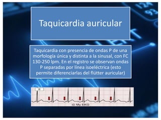 Taquicardia auricular
Taquicardia con presencia de ondas P de una
morfología única y distinta a la sinusal, con FC
130-250 lpm. En el registro se observan ondas
P separadas por línea isoeléctrica (esto
permite diferenciarlas del flútter auricular)
 