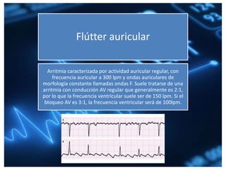 Flútter auricular
Arritmia caracterizada por actividad auricular regular, con
frecuencia auricular a 300 lpm y ondas auriculares de
morfología constante llamadas ondas F. Suele tratarse de una
arritmia con conducción AV regular que generalmente es 2:1,
por lo que la frecuencia ventricular suele ser de 150 lpm. Si el
bloqueo AV es 3:1, la frecuencia ventricular será de 100lpm.
 