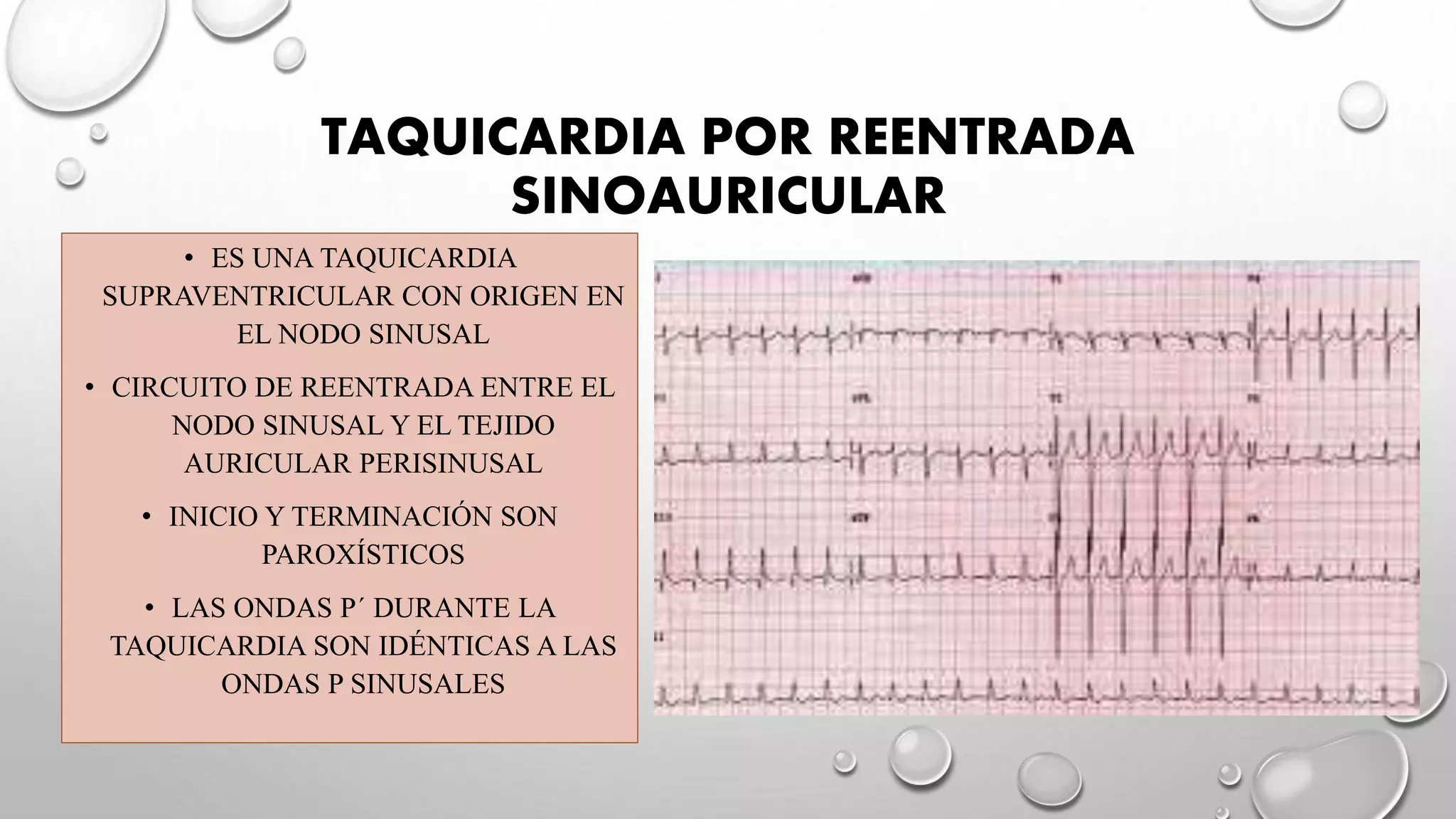 Taquicardias supraventriculares | PPTX