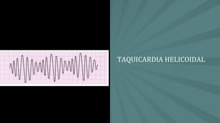 TAQUICARDIA HELICOIDAL
 
