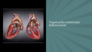 Taquicardia ventricular
bidireccional
 