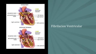 Fibrilacion Ventricular
 