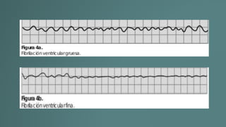 Taquicardia ventricular.pptx