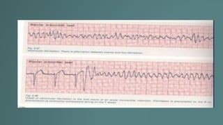 Taquicardia ventricular.pptx