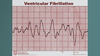 Taquicardia ventricular.pptx