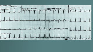 Taquicardia ventricular.pptx