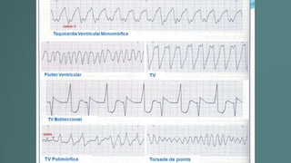 Taquicardia ventricular.pptx