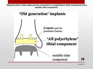 ‘Old generation’ ankle replacements consisted of a polyethylene tibial component and a
metallic talar component.
29
5/10/2015
 