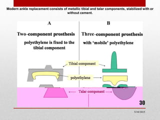 Modern ankle replacement consists of metallic tibial and talar components, stabilized with or
without cement.
30
5/10/2015
 
