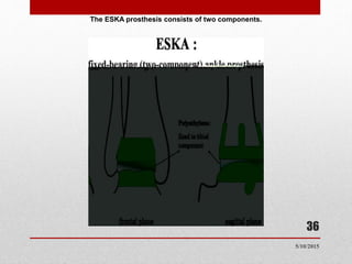 The ESKA prosthesis consists of two components.
36
5/10/2015
 