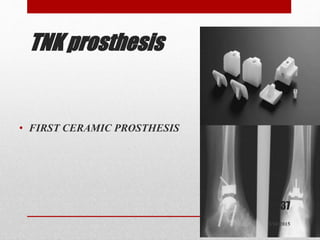TNK prosthesis
• FIRST CERAMIC PROSTHESIS
37
5/10/2015
 