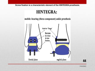 Screw fixation is a characteristic element of the HINTEGRA prosthesis.
44
5/10/2015
 