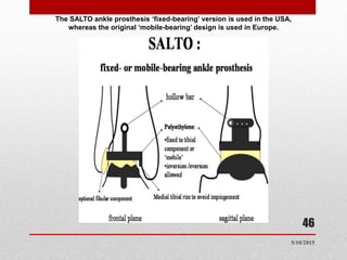 The SALTO ankle prosthesis ‘fixed-bearing’ version is used in the USA,
whereas the original ‘mobile-bearing’ design is used in Europe.
46
5/10/2015
 