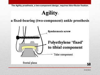 The Agility prosthesis, a two-component design, requires tibio-fibular fixation.
50
5/10/2015
 