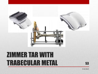 ZIMMER TAR WITH
TRABECULAR METAL 53
5/10/2015
 