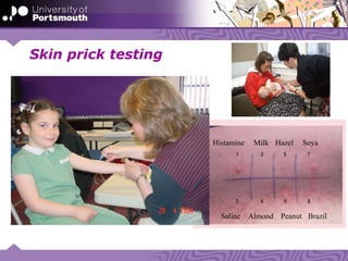 Skin prick testing
Histamine HazelMilk
PeanutAlmondSaline
Soya
Brazil
 