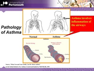 Pathology
of Asthma
Source: “What You and Your Family Can Do About Asthma”
by the Global Initiative For Asthma Created and funded by NIH/NHLBI, 1995
Normal Asthma
Asthma involves
inflammation of
the airways
 