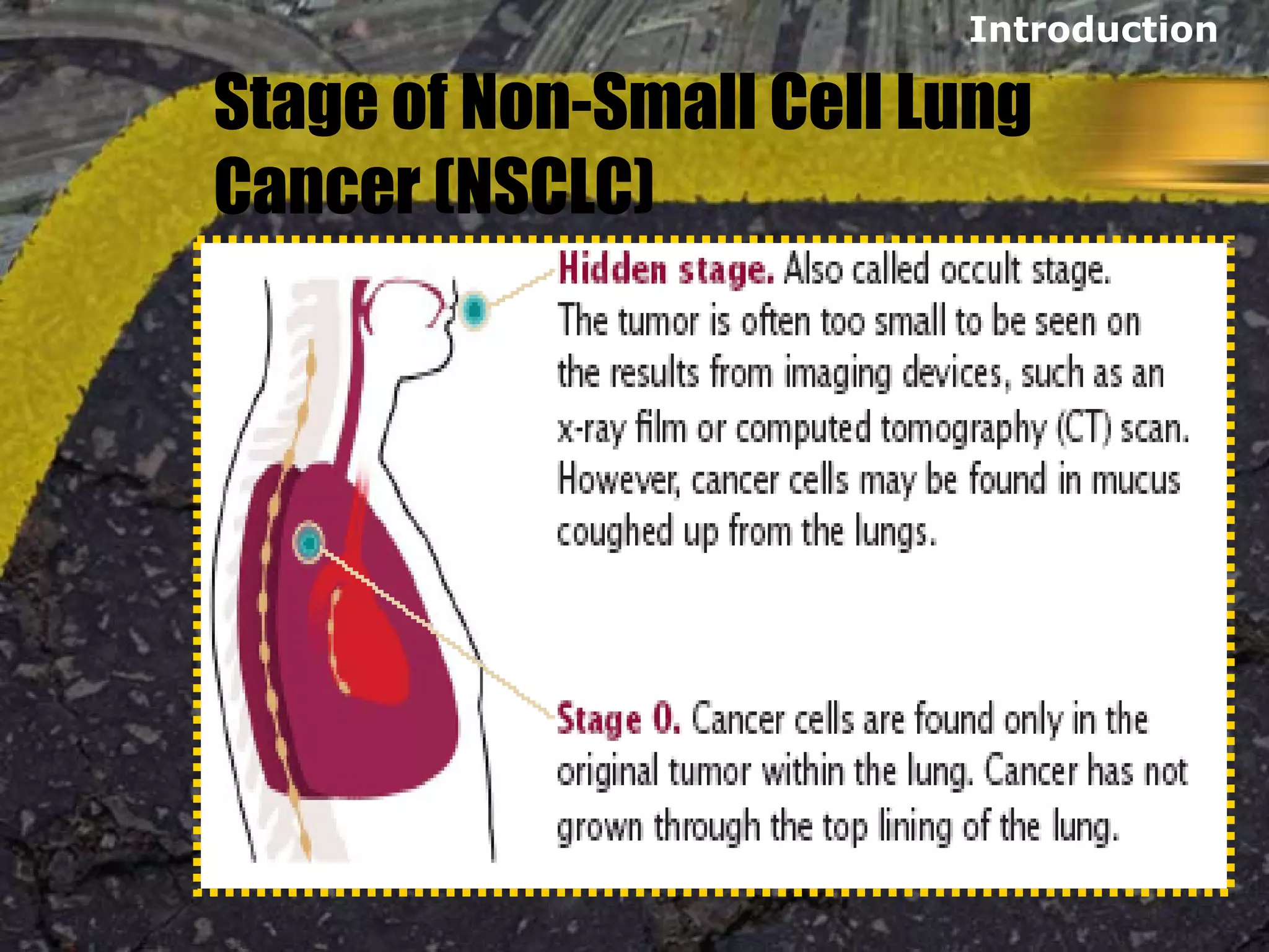 Stage of Non-Small Cell Lung
Cancer (NSCLC)
Introduction
 