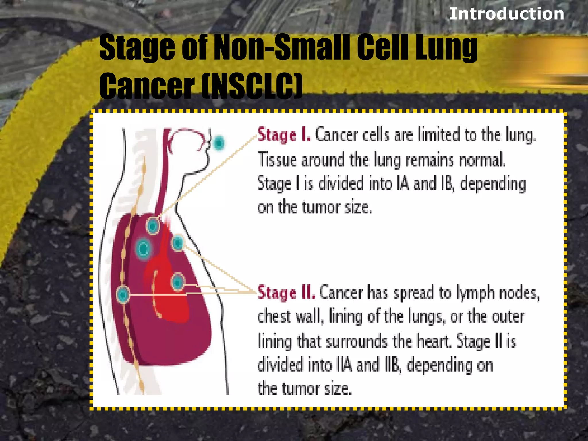 Stage of Non-Small Cell Lung
Cancer (NSCLC)
Introduction
 