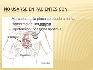 NO USARSE EN PACIENTES CON:
  Marcapasos:  la placa se puede calentar
  Hemorragias: las agrava

  Hipotensión: ocasiona lipotimia
 
