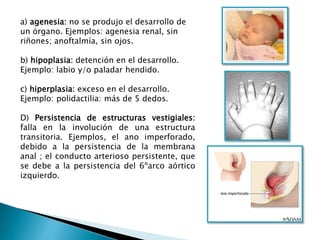 a) agenesia: no se produjo el desarrollo de
un órgano. Ejemplos: agenesia renal, sin
riñones; anoftalmía, sin ojos.
b) hipoplasia: detención en el desarrollo.
Ejemplo: labio y/o paladar hendido.
c) hiperplasia: exceso en el desarrollo.
Ejemplo: polidactilia: más de 5 dedos.
D) Persistencia de estructuras vestigiales:
falla en la involución de una estructura
transitoria. Ejemplos, el ano imperforado,
debido a la persistencia de la membrana
anal ; el conducto arterioso persistente, que
se debe a la persistencia del 6ºarco aórtico
izquierdo.
 