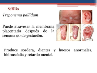Sífilis
Treponema pallidum
Puede atravesar la membrana
placentaria después de la
semana 20 de gestación.
Produce sordera, dientes y huesos anormales,
hidrocefalia y retardo mental.
 