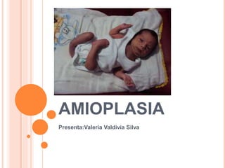 AMIOPLASIA
Presenta:Valeria Valdivia Silva
 