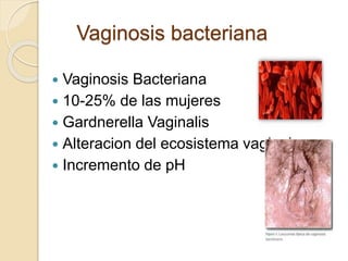 Vaginosis bacteriana 
 Vaginosis Bacteriana 
 10-25% de las mujeres 
 Gardnerella Vaginalis 
 Alteracion del ecosistema vaginal 
 Incremento de pH 
 