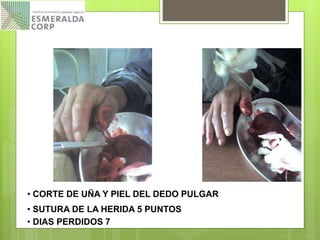 • CORTE DE UÑA Y PIEL DEL DEDO PULGAR
• SUTURA DE LA HERIDA 5 PUNTOS
• DIAS PERDIDOS 7
 