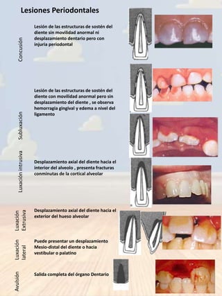 Traumatismos Dentales en Odontología Infantil  Slide 6