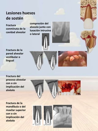 Traumatismos Dentales en Odontología Infantil  Slide 8
