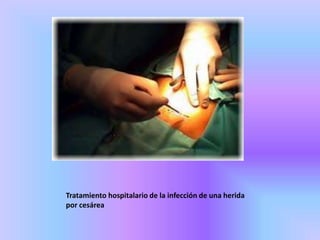” Tratamiento hospitalario de la infección de
        una herida por cesárea”




Tratamiento hospitalario de la infección de una herida
por cesárea
 