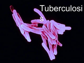 Tuberculosi
s
 