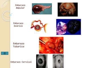 Embarazo 
Ampular 
Embarazo 
Ovárico 
Embarazo 
Tubarico 
Embarazo Cervical 
 