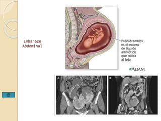Embarazo 
Abdominal 
 