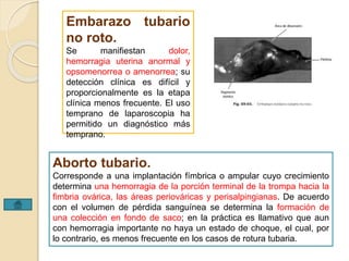 Embarazo tubario 
no roto. 
Se manifiestan dolor, 
hemorragia uterina anormal y 
opsomenorrea o amenorrea; su 
detección clínica es difícil y 
proporcionalmente es la etapa 
clínica menos frecuente. El uso 
temprano de laparoscopia ha 
permitido un diagnóstico más 
temprano. 
Aborto tubario. 
Corresponde a una implantación fímbrica o ampular cuyo crecimiento 
determina una hemorragia de la porción terminal de la trompa hacia la 
fimbria ovárica, las áreas periováricas y perisalpingianas. De acuerdo 
con el volumen de pérdida sanguínea se determina la formación de 
una colección en fondo de saco; en la práctica es llamativo que aun 
con hemorragia importante no haya un estado de choque, el cual, por 
lo contrario, es menos frecuente en los casos de rotura tubaria. 
 