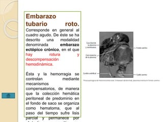 Embarazo 
tubario roto. 
Corresponde en general al 
cuadro agudo. De éste se ha 
descrito una modalidad 
denominada embarazo 
ectópico crónico, en el que 
hay rotura y 
descompensación 
hemodinámica. 
Ésta y la hemorragia se 
controlan mediante 
mecanismos 
compensatorios, de manera 
que la colección hemática 
peritoneal de predominio en 
el fondo de saco se organiza 
como hematoma, que al 
paso del tiempo sufre lisis 
parcial y permanece por 
algún tiempo en su sitio. 
 