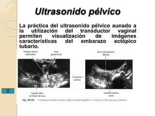 Ultrasonido pélvico 
La práctica del ultrasonido pélvico aunado a 
la utilización del transductor vaginal 
permiten visualización de imágenes 
características del embarazo ectópico 
tubario. 
 