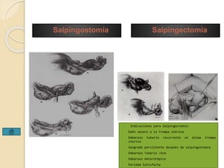 Salpingostomía Salpingectomía 
 Indicaciones para Salpingectomía: 
• Daño severo a la trompa uterina 
• Embarazo tubario recurrente en misma trompa 
uterina 
• Sangrado persistente despúes de salpingostomía 
• Embarazo Tubario >5cm 
• Embarazo Heterotópico 
• Paridad Satisfecha 
 