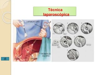Técnica 
laparoscópica 
 