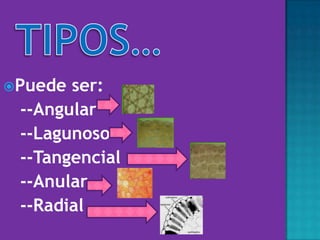 Puede ser:
--Angular
--Lagunoso
--Tangencial
--Anular
--Radial
 