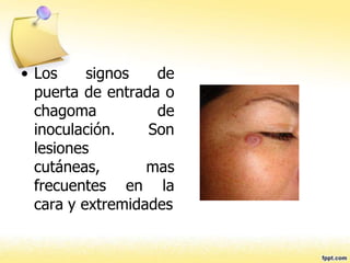 • Los signos de
puerta de entrada o
chagoma de
inoculación. Son
lesiones
cutáneas, mas
frecuentes en la
cara y extremidades
 