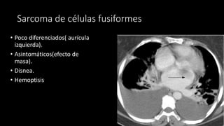 Sarcoma de células fusiformes
• Poco diferenciados( aurícula
izquierda).
• Asintomáticos(efecto de
masa).
• Disnea.
• Hemoptisis
 